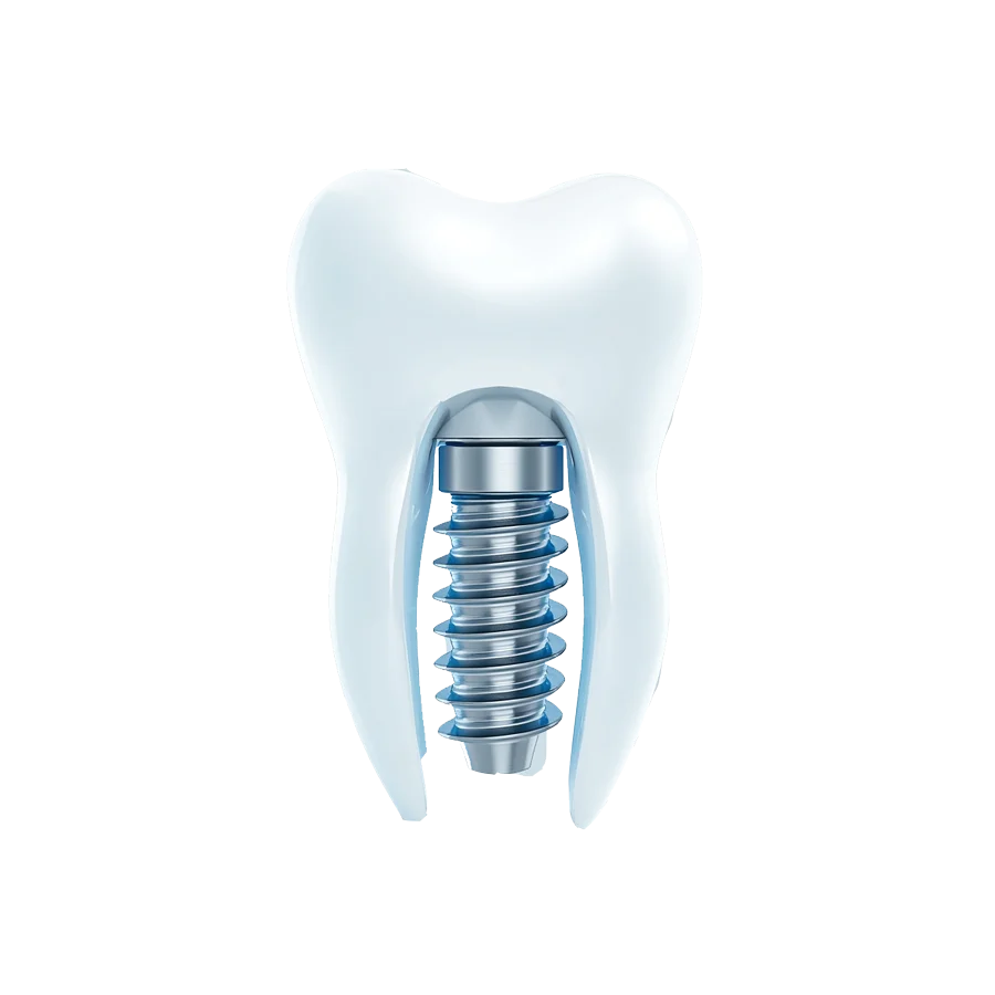 Implantes Dentales en Logroño